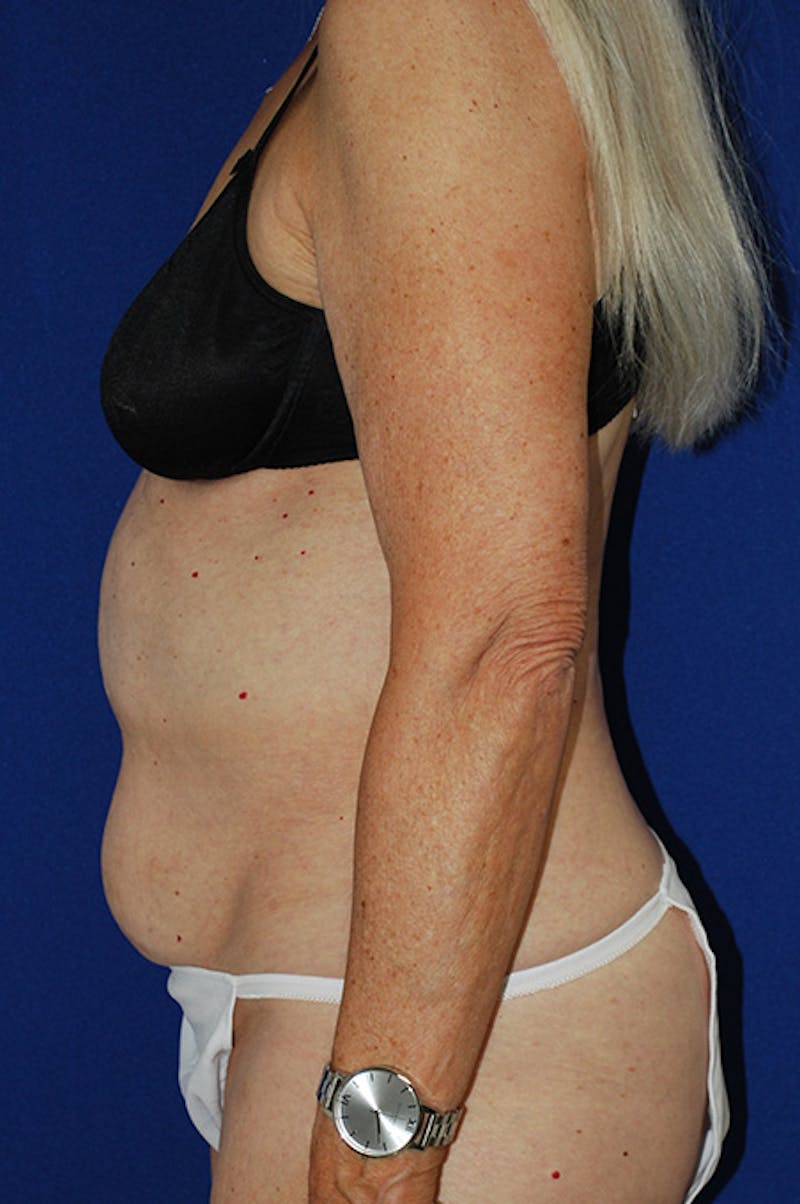 Abdominoplasty Before & After Gallery - Patient 266099 - Image 3