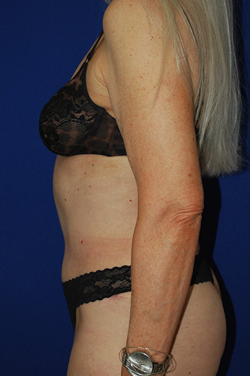 Abdominoplasty Before & After Gallery - Patient 266099 - Image 4