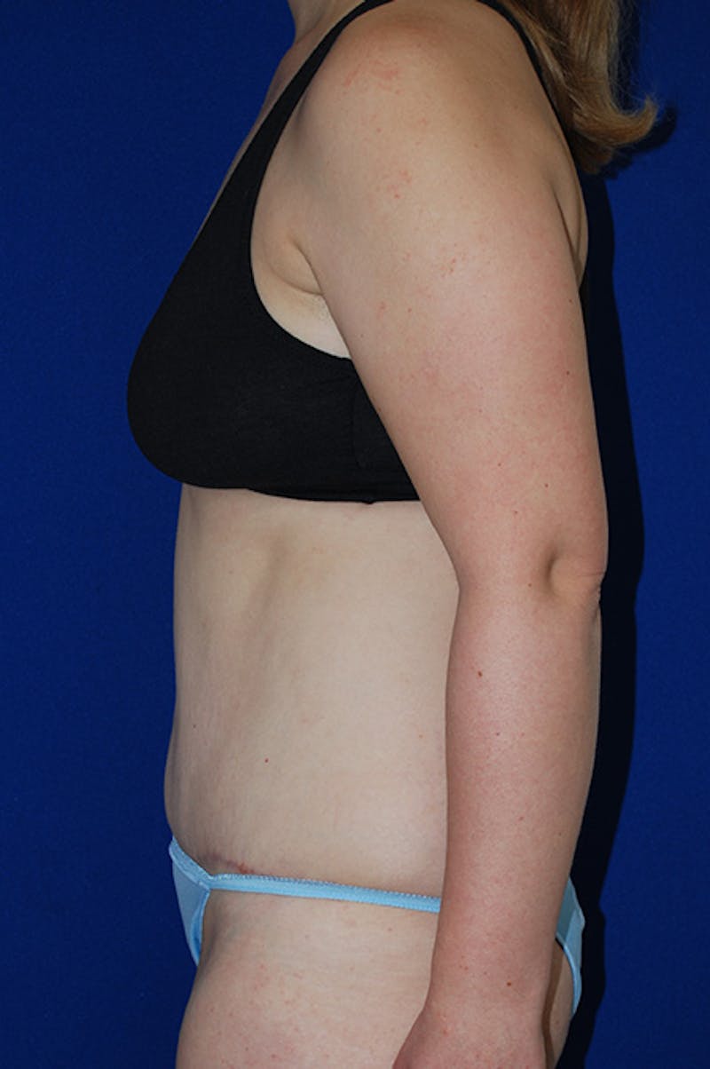 Abdominoplasty Before & After Gallery - Patient 268776 - Image 6