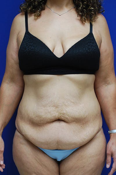 Abdominoplasty Before & After Gallery - Patient 155978 - Image 1