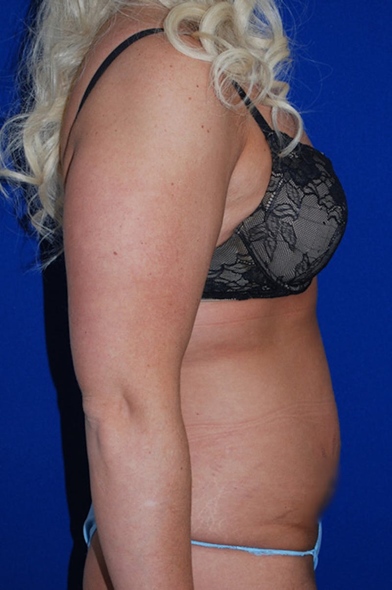 Abdominoplasty Before & After Gallery - Patient 402331 - Image 3