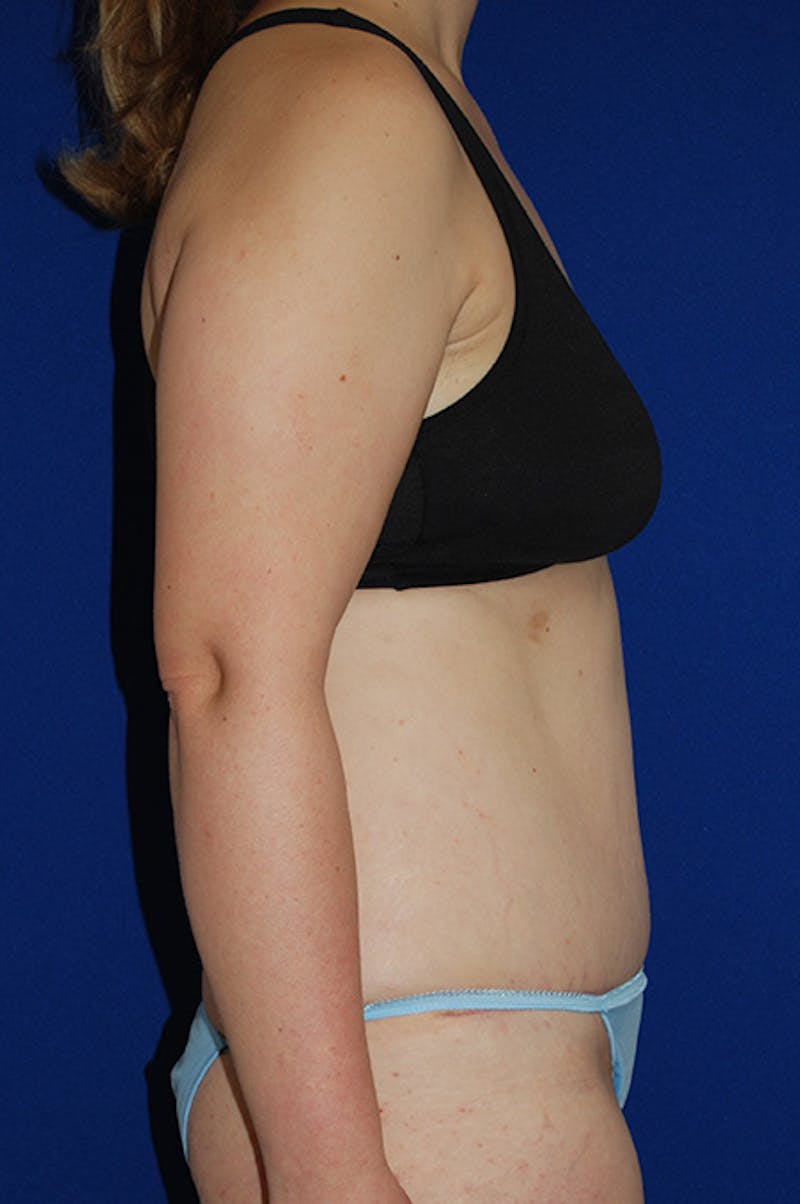 Abdominoplasty Before & After Gallery - Patient 268776 - Image 4