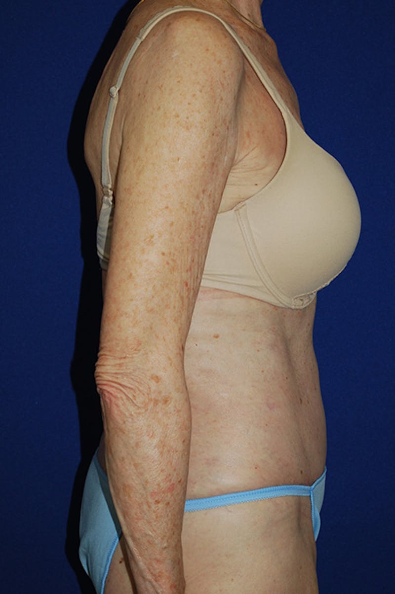 Abdominoplasty Before & After Gallery - Patient 316063 - Image 4