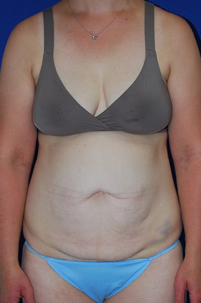 Abdominoplasty Before & After Gallery - Patient 268776 - Image 1