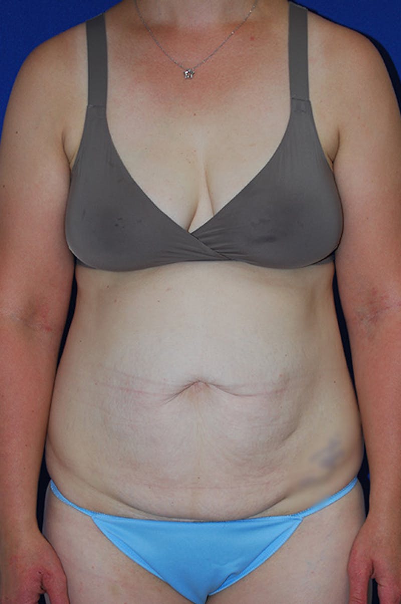Abdominoplasty Before & After Gallery - Patient 268776 - Image 1