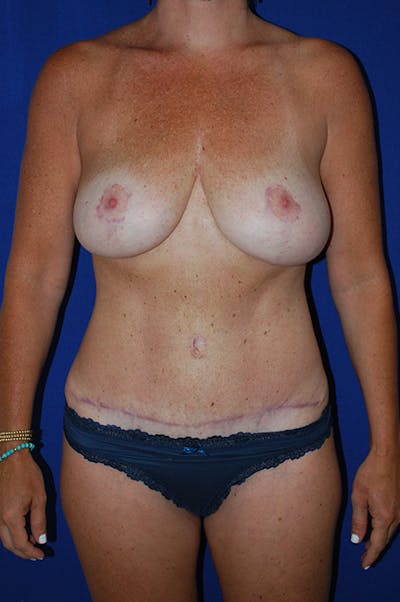 Abdominoplasty Before & After Gallery - Patient 319360 - Image 2
