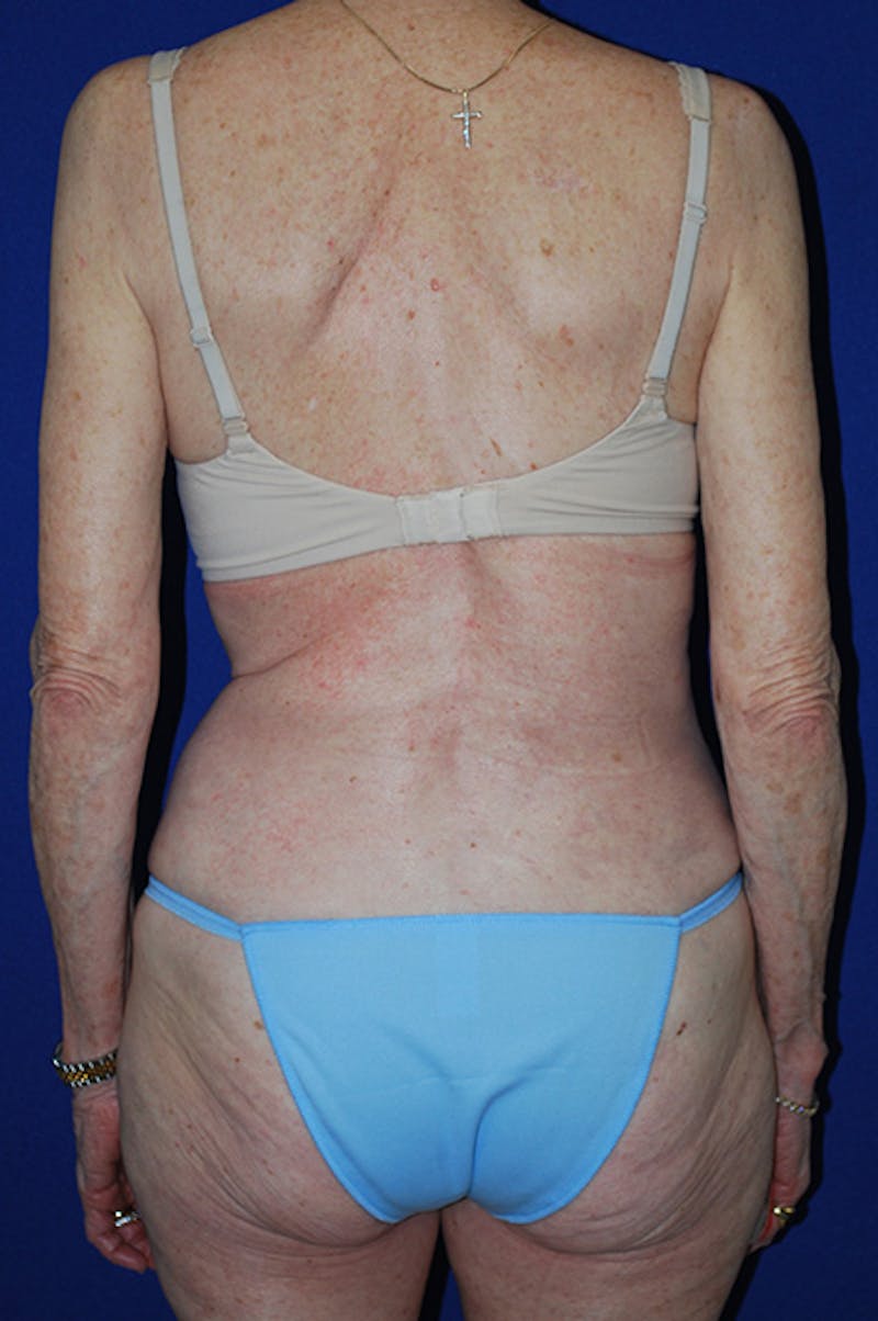 Abdominoplasty Before & After Gallery - Patient 316063 - Image 6