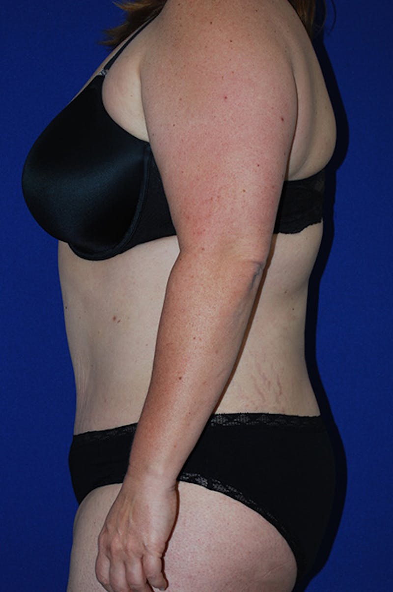 Abdominoplasty Before & After Gallery - Patient 869180 - Image 6
