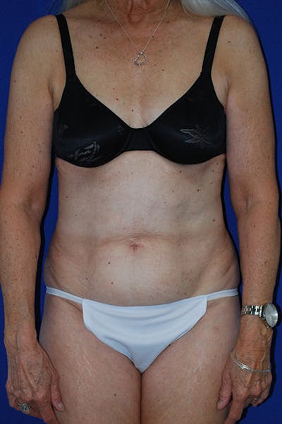 Abdominoplasty Before & After Gallery - Patient 266099 - Image 1
