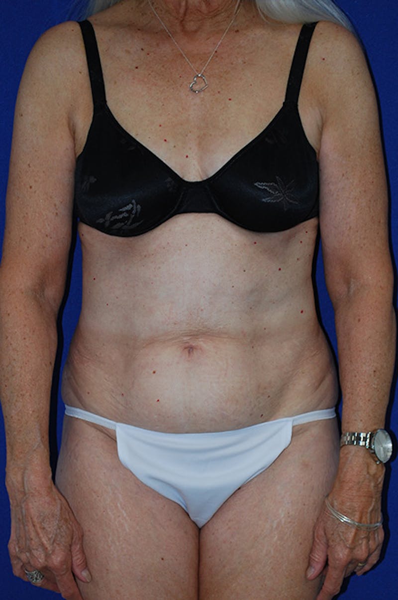 Abdominoplasty Before & After Gallery - Patient 266099 - Image 1