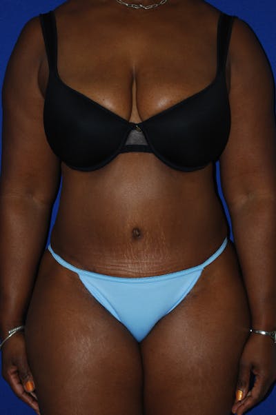 Abdominoplasty Before & After Gallery - Patient 150699 - Image 2