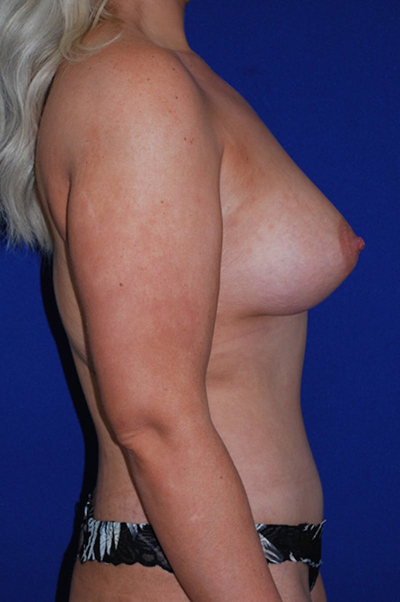 Abdominoplasty Before & After Gallery - Patient 402331 - Image 4