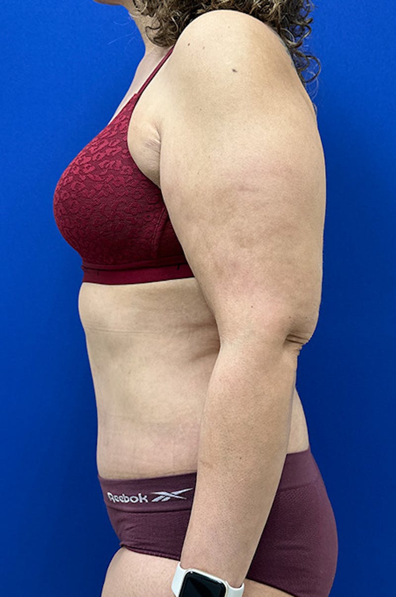 Abdominoplasty Before & After Gallery - Patient 341849 - Image 6