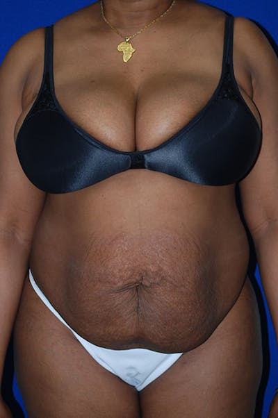 Abdominoplasty Before & After Gallery - Patient 982076 - Image 1