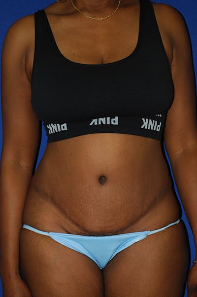 Abdominoplasty Before & After Gallery - Patient 982076 - Image 2