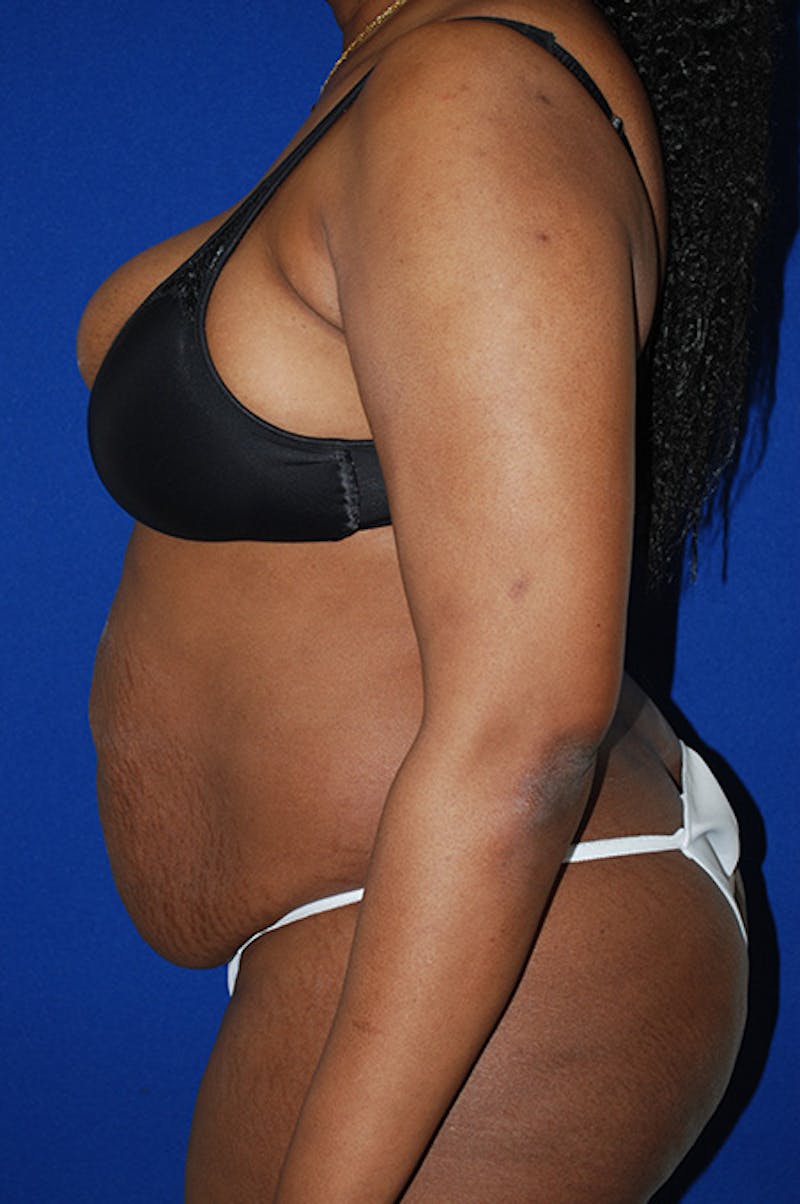 Abdominoplasty Before & After Gallery - Patient 982076 - Image 5