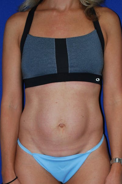 Abdominoplasty Before & After Gallery - Patient 227946 - Image 1