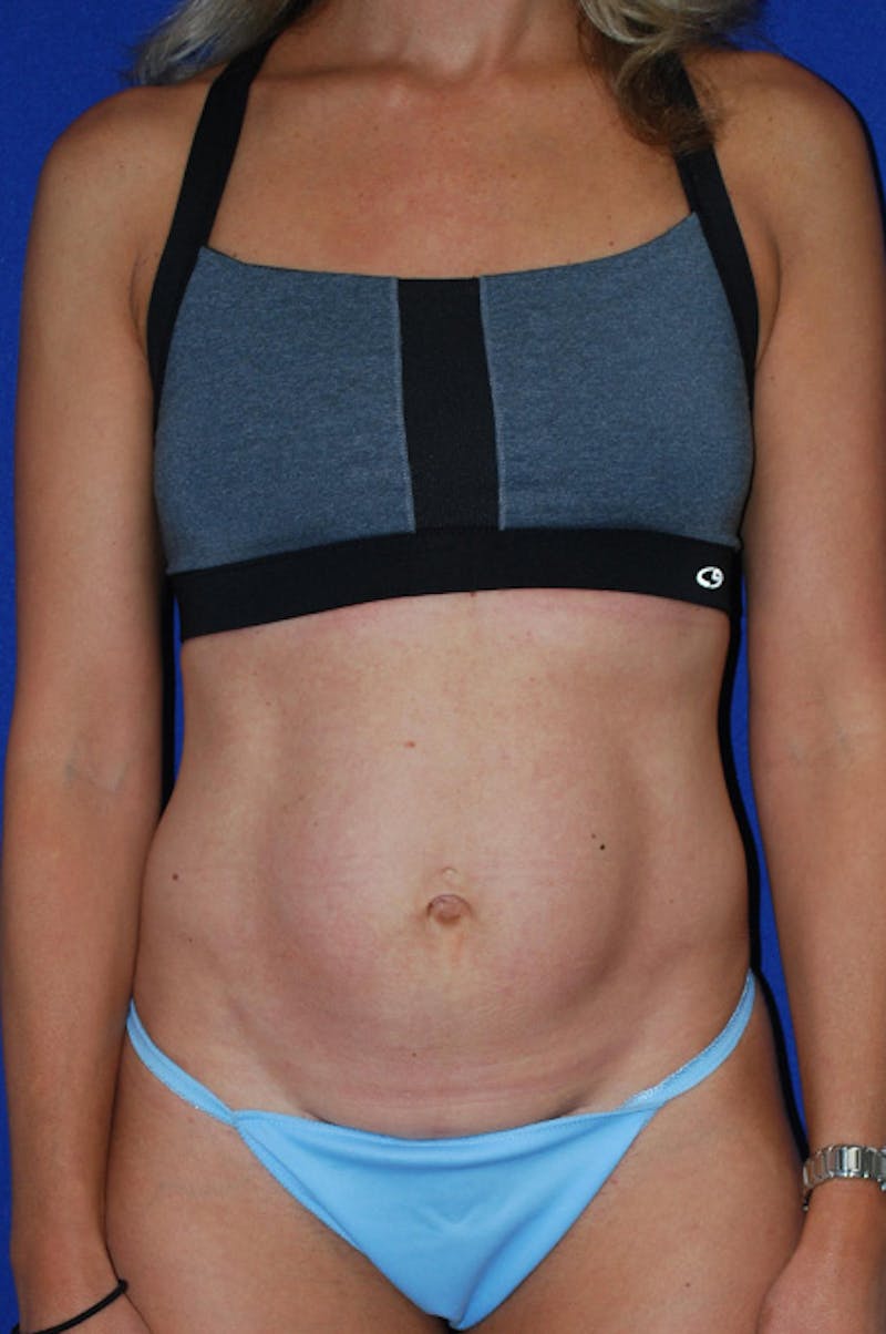 Abdominoplasty Before & After Gallery - Patient 227946 - Image 1