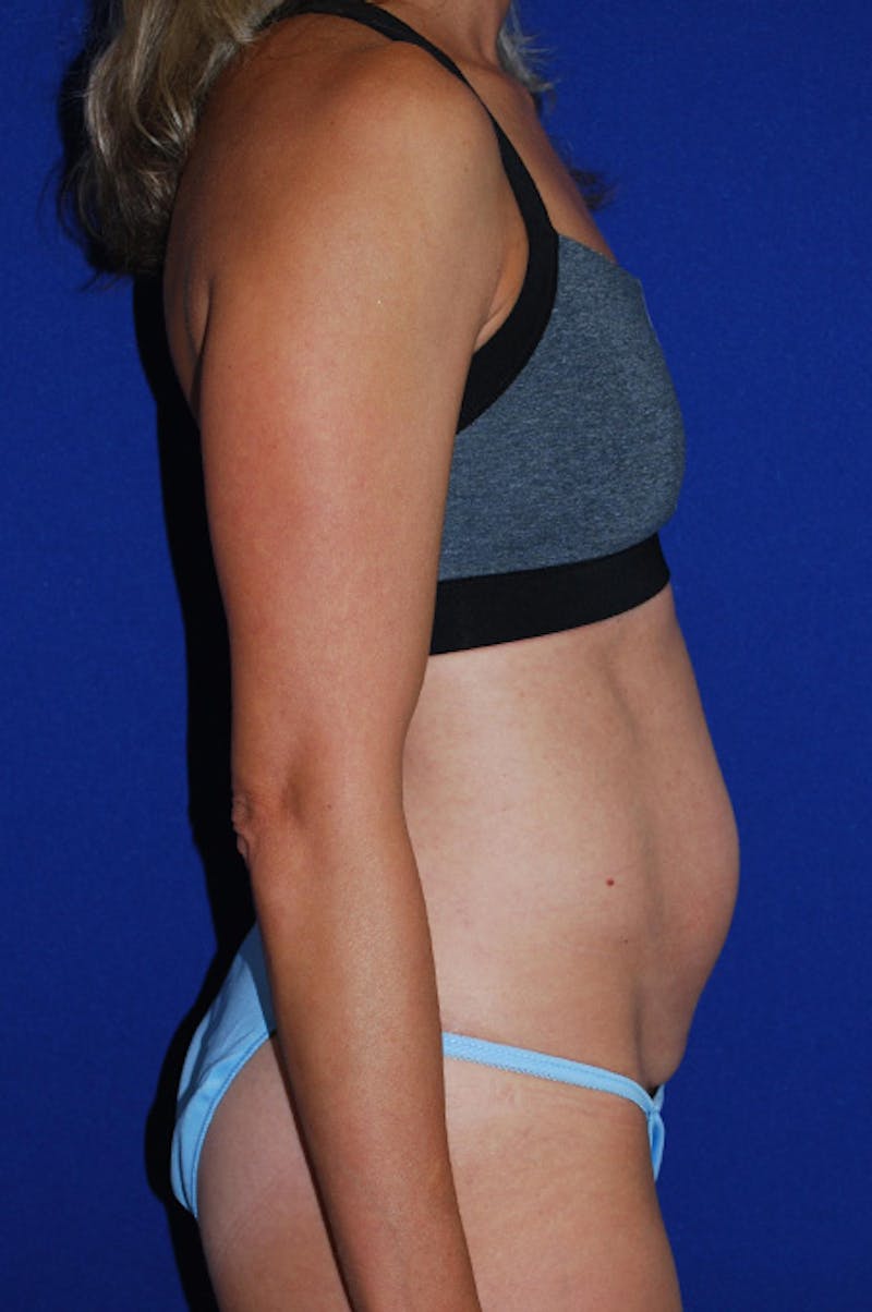Abdominoplasty Before & After Gallery - Patient 227946 - Image 3