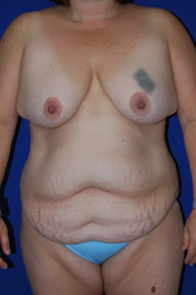 Abdominoplasty Before & After Gallery - Patient 869180 - Image 1