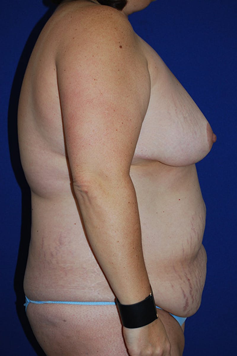 Abdominoplasty Before & After Gallery - Patient 869180 - Image 3