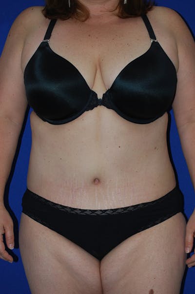 Abdominoplasty Before & After Gallery - Patient 869180 - Image 2