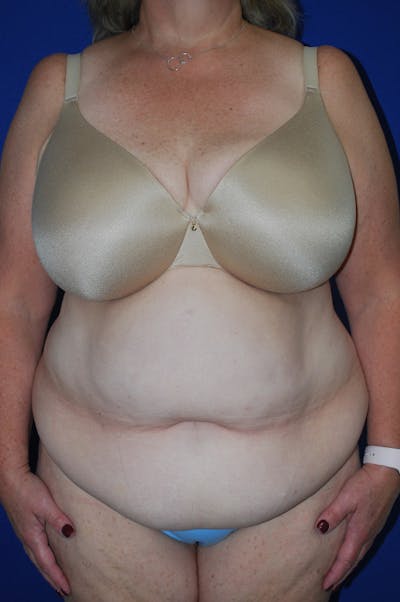 Abdominoplasty Before & After Gallery - Patient 417959 - Image 2