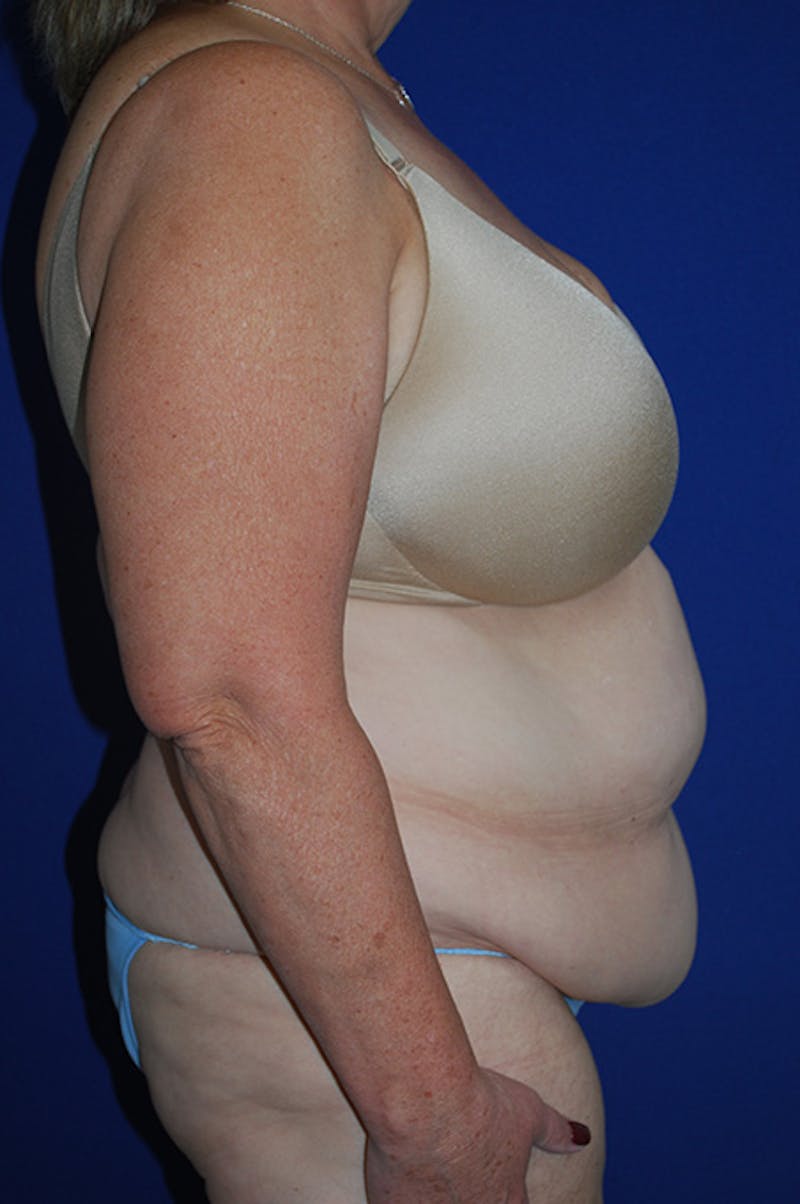 Abdominoplasty Before & After Gallery - Patient 417959 - Image 3