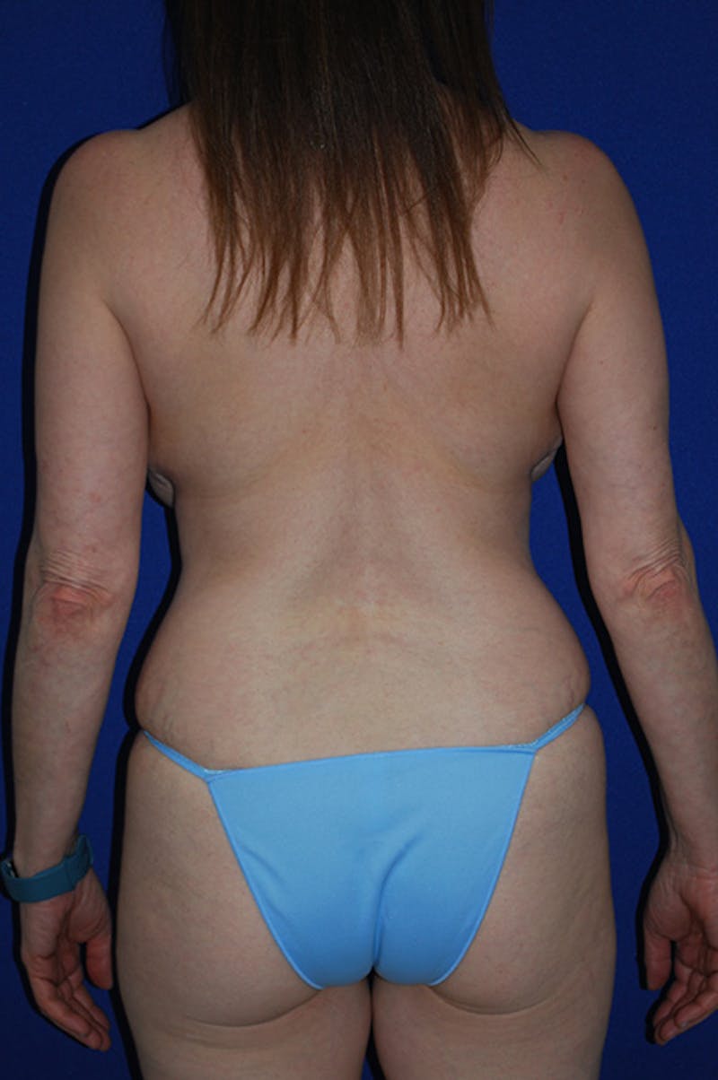Abdominoplasty Before & After Gallery - Patient 364621 - Image 5