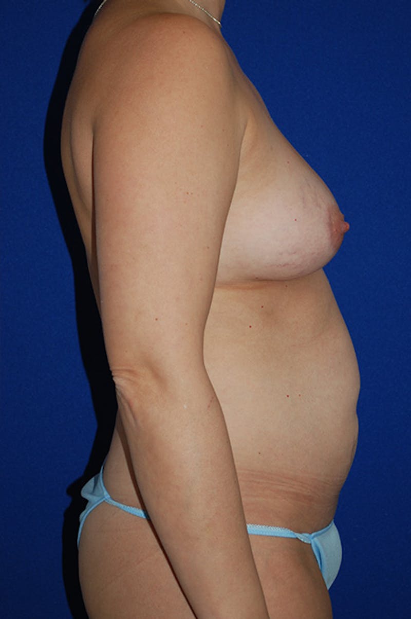 Abdominoplasty Before & After Gallery - Patient 278508 - Image 5