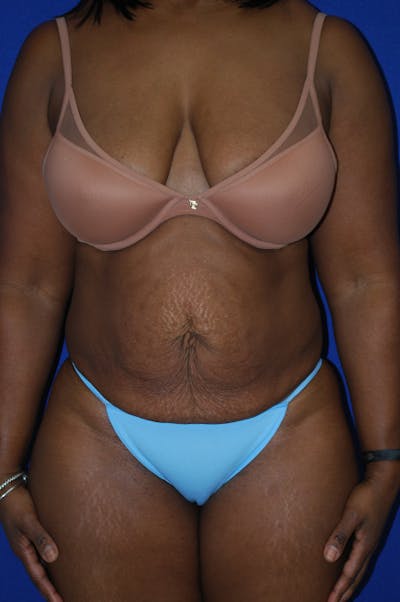 Abdominoplasty Before & After Gallery - Patient 150699 - Image 1