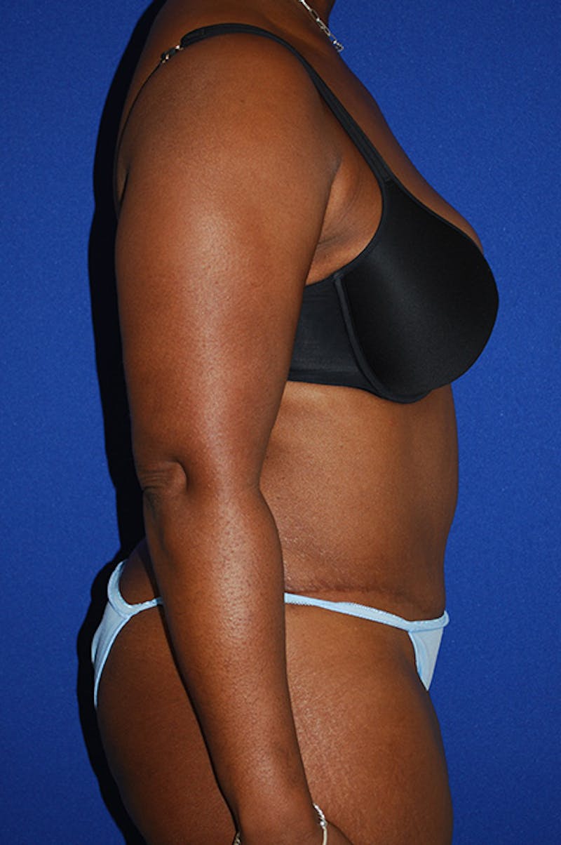 Abdominoplasty Before & After Gallery - Patient 150699 - Image 4