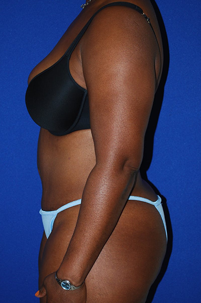 Abdominoplasty Before & After Gallery - Patient 150699 - Image 6