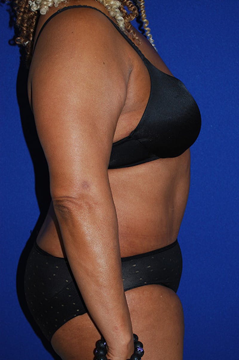 Abdominoplasty Before & After Gallery - Patient 320975 - Image 6