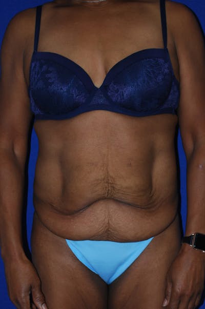 Abdominoplasty Before & After Gallery - Patient 320975 - Image 1
