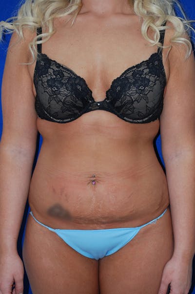Abdominoplasty Before & After Gallery - Patient 402331 - Image 1