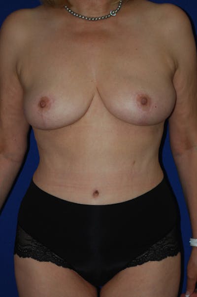 Abdominoplasty Before & After Gallery - Patient 310902 - Image 2
