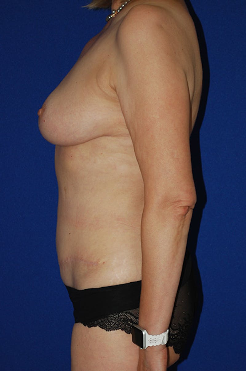 Abdominoplasty Before & After Gallery - Patient 310902 - Image 6