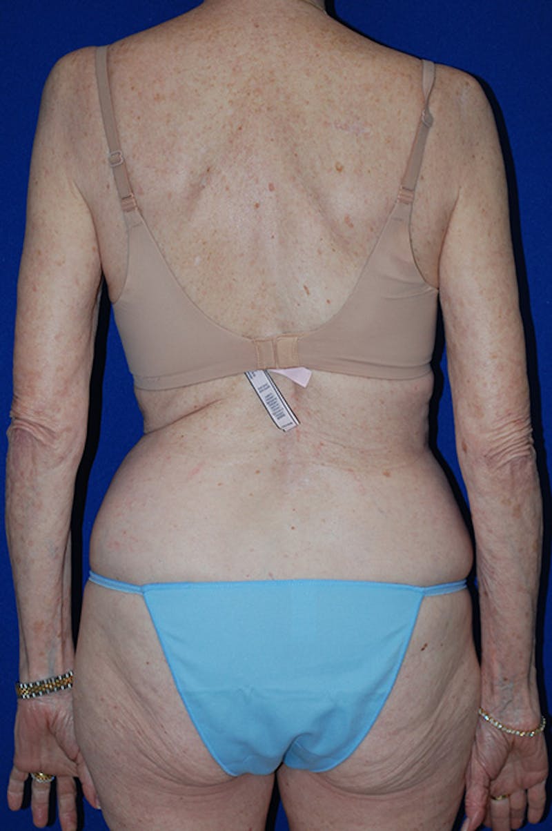 Abdominoplasty Before & After Gallery - Patient 316063 - Image 5