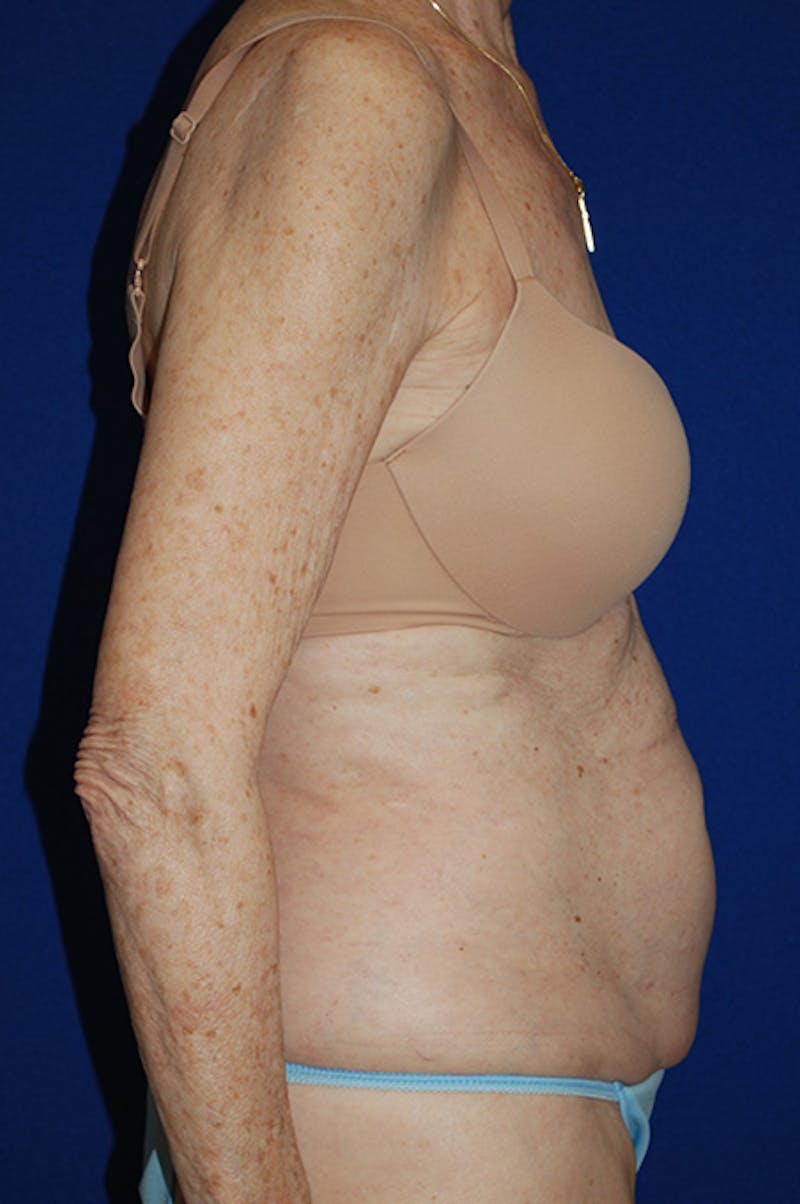 Abdominoplasty Before & After Gallery - Patient 316063 - Image 3