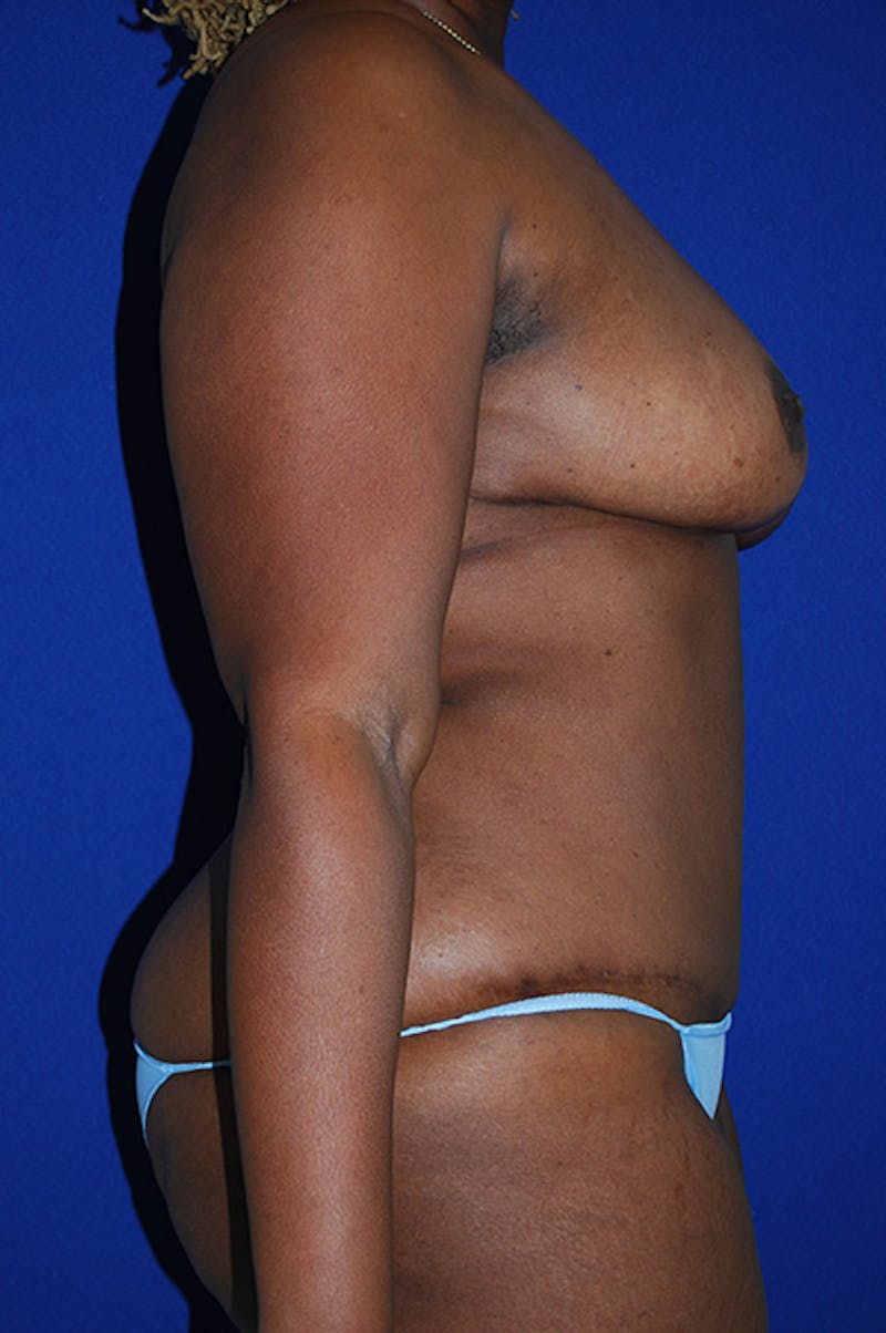 Abdominoplasty Before & After Gallery - Patient 341849 - Image 4