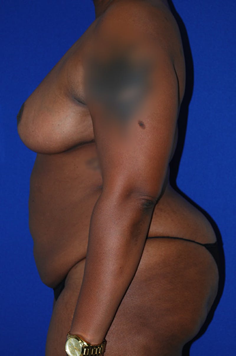 Abdominoplasty Before & After Gallery - Patient 341849 - Image 5