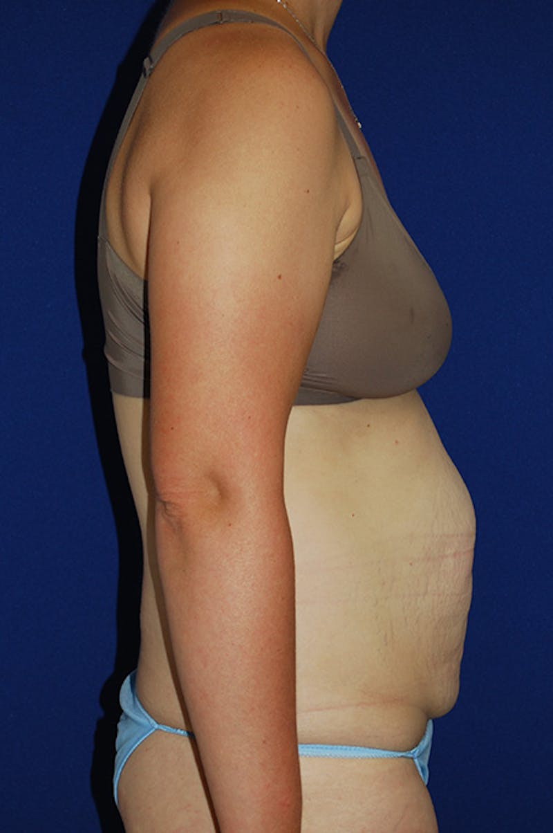 Abdominoplasty Before & After Gallery - Patient 268776 - Image 3