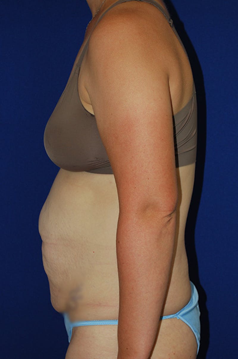 Abdominoplasty Before & After Gallery - Patient 268776 - Image 5