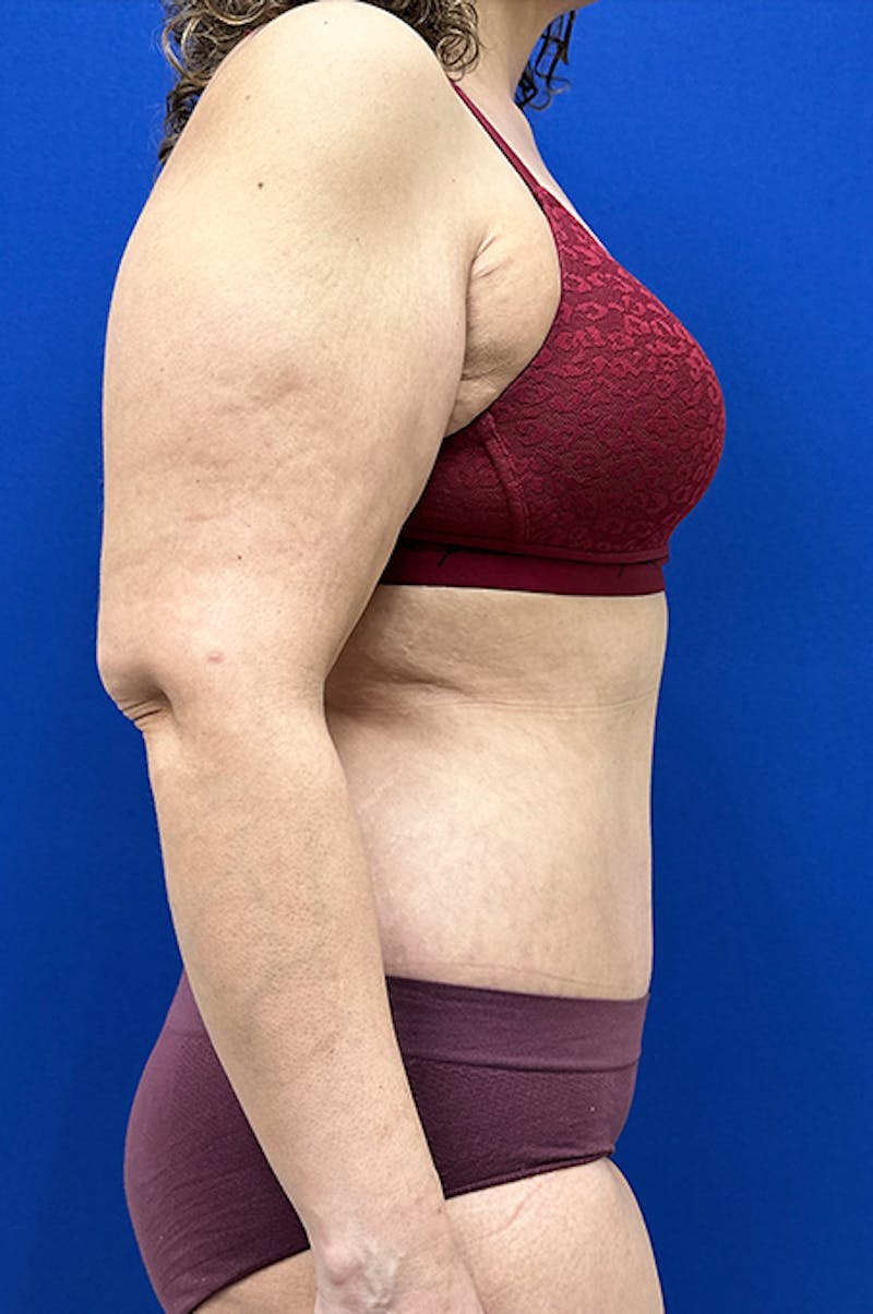 Abdominoplasty Before & After Gallery - Patient 155978 - Image 4