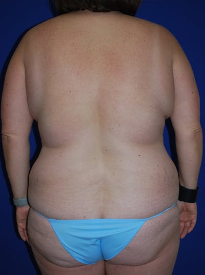 Liposuction Before & After Gallery - Patient 371226 - Image 1