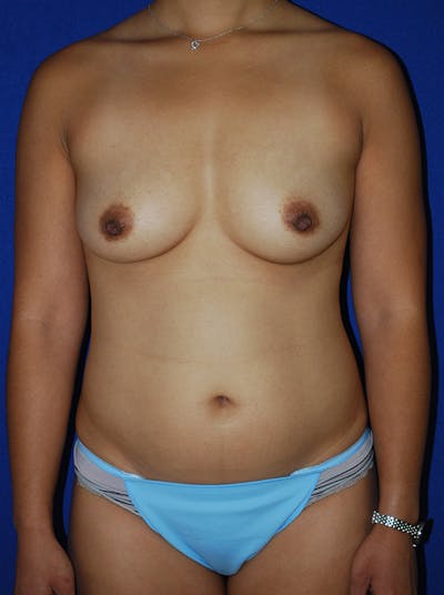 Liposuction Before & After Gallery - Patient 298853 - Image 1