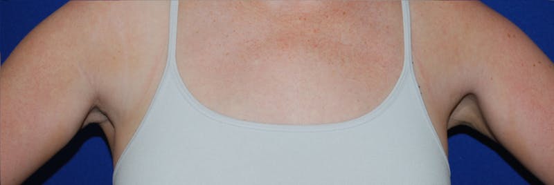 Liposuction Before & After Gallery - Patient 793488 - Image 6