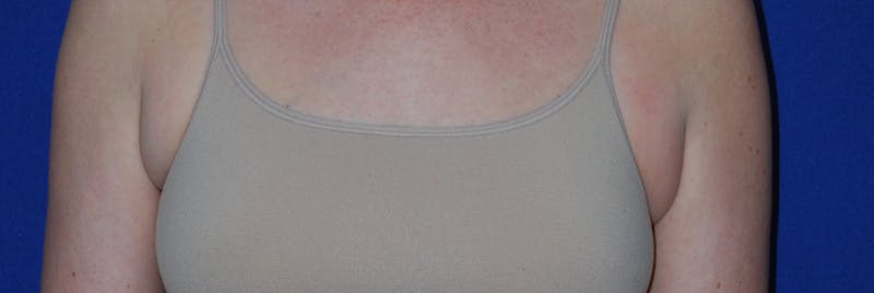 Liposuction Before & After Gallery - Patient 793488 - Image 3