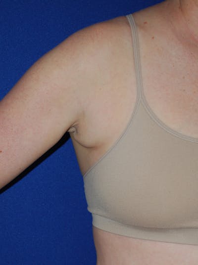 Liposuction Before & After Gallery - Patient 793488 - Image 1